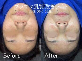 エイトスキン(8skin)/プラズマ肌質改善(毛穴洗浄付)