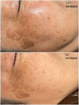 桜/最新光フェイシャル