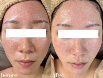 ホワイトアクア 北千住店(WHITE AQUA)/ハーブピーリング1回/ニキビケア