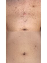 スキンラウンジ(SKIN LOUNGE)/圧倒的効果｜LED脱毛