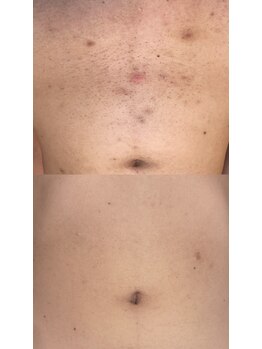 スキンラウンジ(SKIN LOUNGE)/圧倒的効果｜LED脱毛