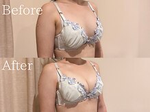 ナリッシュ バスト 六本木(Nouriche Bust)/バストアップ◇ビフォーアフター