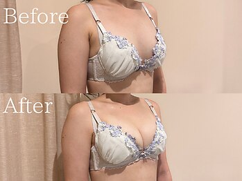 ナリッシュ バスト 六本木(Nouriche Bust)/バストアップ◇ビフォーアフター