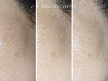 アート ビューティールーム(art beauty room)/☆Dactor Peel （ダクトピール）