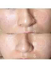 ソワ 吉塚店(soi)/たるみ毛穴にも☆