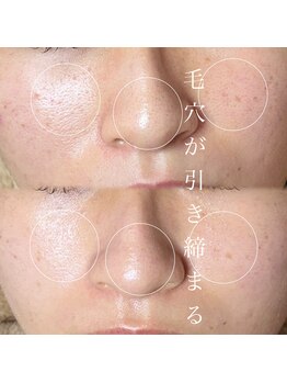 ソワ 吉塚店(soi)/たるみ毛穴にも☆