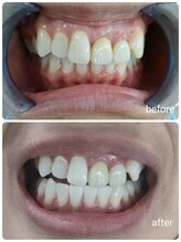 ルアナシンフォニア エクシア 東銀座店(Luana-Sinfonia)/ホワイトニングビフォーアフター