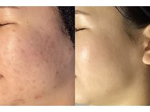 ハーブピーリング&毛穴洗浄専門店 肌REVO 高田馬場店[ニキビ/毛穴/たるみ/美白/シミ]/ハーブピーリング/ニキビケア