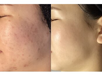 ハーブピーリング&毛穴洗浄専門店 肌REVO 高田馬場店[ニキビ/毛穴/たるみ/美白/シミ]/ハーブピーリング/ニキビケア