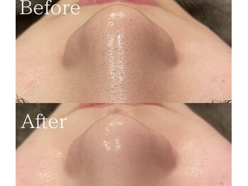 ララ(Lala)の写真/【大人気毛穴洗浄】頑固な黒ずみ・角栓を徹底オフ！鎮静パックセットでキュッと引き締まった肌へ◎