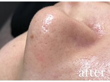 リリーブー 池袋(Lilyboo)/毛穴洗浄ハイドラフェイシャル