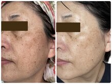 ステラ(stella)/肌質改善