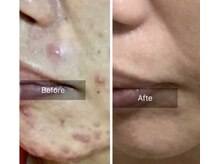 エミルカ(EMILUCA)/ハーブピーリングでお悩み改善