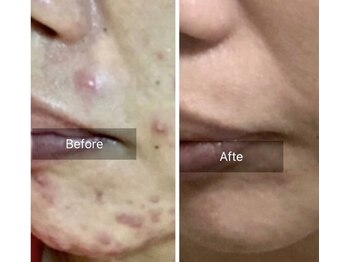 エミルカ(EMILUCA)/ハーブピーリングでお悩み改善