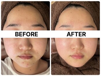 ハーブピーリング 恵比寿/ニキビケア/浮腫み/リフトアップ