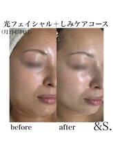 アンドエス(&S.)/光フェイシャル＋シミ改善☆