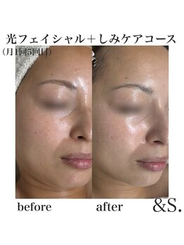 アンドエス(&S.)/光フェイシャル+シミ改善☆