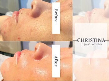 エープラス(A+)/ビオフィート