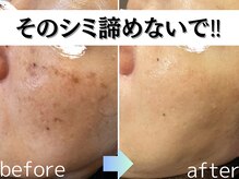 パールホワイトニングサロン 茅ヶ崎店の雰囲気（シミケア+素肌も綺麗に◎ 大小問わずケア可能）