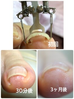 ネイルサロン マリング(Nail Salon Maring)/☆お爪の巻きをケア☆