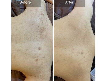 エミルカ(EMILUCA)/ハーブピーリングでお悩み改善