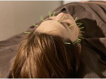 ハリルル 併設 GLケンタ鍼灸整骨院(HARILULU)/美容鍼