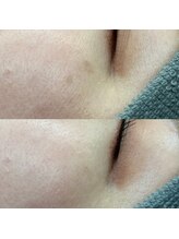 ヘアデザインアンドエステティック リコ(hair design&esthetic rico)/シミケアプラズマ