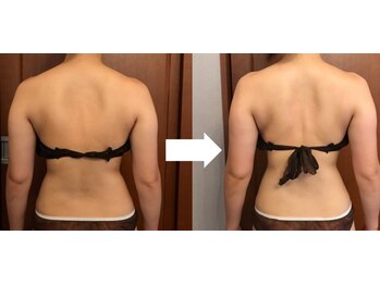 ヴァン ベール 那覇店/背中×二の腕ケア