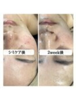 ル ボヌール 伊那店(le bonheur)/シミケア　垢化2回