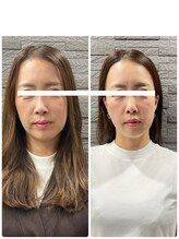 長寿鍼灸院 長寿整骨院/ハリネズミ女優美容鍼効果★