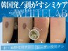 【秋田県内初！大人気最新シミ改善施術☆ホワイトラボ】1箇所11,000円