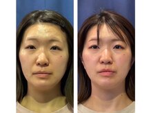 カナヤ鍼灸整骨院/美容鍼ビフォーアフター★