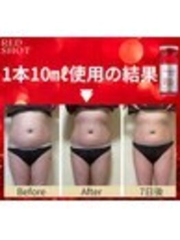 ラキュア(La Cure)の写真/結果重視！脂肪分解レッドショットRED SHOT×キャビテーションで、悩めるボディ、たるみもケア♪