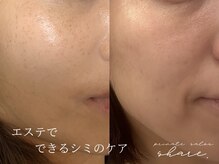 シェア(share.)の雰囲気(エステでもシミケアができる◎アンストレス/イラストリアス/毛穴)