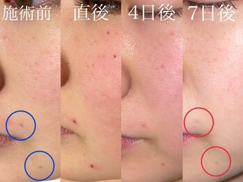 アイリープ(eyeleap)/☆頑固なシミケアに！筋膜リフト