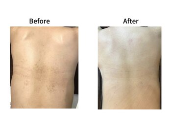 エミルカ(EMILUCA)/ハーブピーリングでお悩み改善