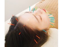 おもいやり鍼灸治療院 モーイ(mooi)/美容鍼で肌質改善