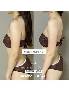 エヌボーテ(N. beaute)/Before→After 5回目