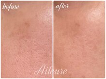 エルール トータルビューティ(Aileure total beauty)/最新ピーリング　ララピール