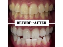 ホワイトニングサロン 豊中/Before&After美白ホワイトニング