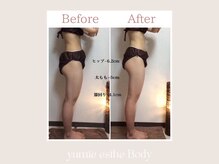 トータルビューティー ゆみえエステ(Total Beauty)/痩身/ハイパーナイフ/下半身