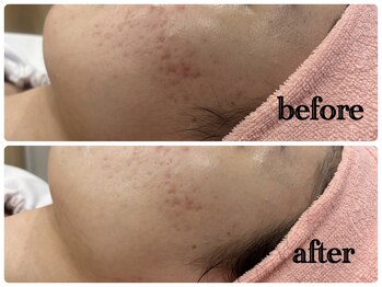 シルク(Cilk)/ハーブクリームピーリング