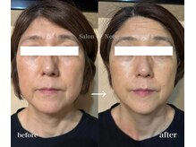 サロン ド ノイエ(Salon de Neue)/コラーゲンフィラーULDM