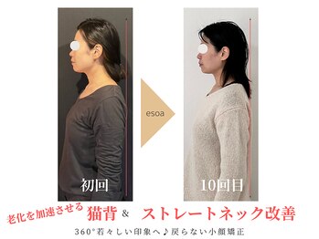 エソア(esoa)/50代 改善小顔矯正