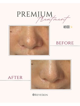 レーヴスキン(Reve Skin)/プレミアムケア初回