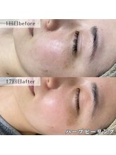 ネイルズビー 別邸(Nail's be)/【劇的変化】ハーブピーリング