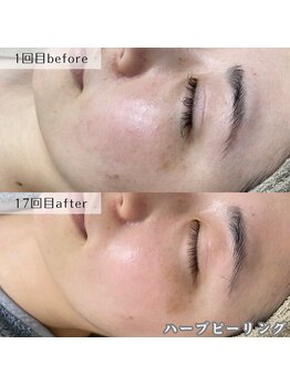 ネイルズビー 別邸(Nail's be)/【劇的変化】ハーブピーリング