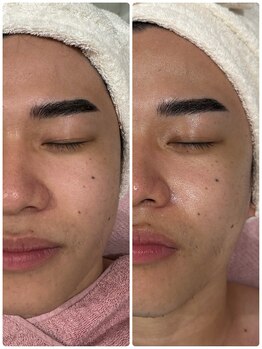 エーエフビューティーエステ(AF Beauty Esthetic)の写真/毛穴・たるみ・ニキビ・敏感肌対応｜クリスティーナ肌質改善