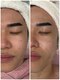 エーエフビューティーエステ(AF Beauty Esthetic)の写真/毛穴・たるみ・ニキビ・敏感肌対応｜クリスティーナ肌質改善