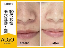 アルゴ 豊中岡町駅前店(ALGO)/【毛穴洗浄+光脱毛】